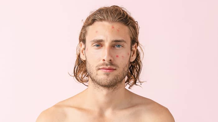 Man met acne voor roze achtergrond