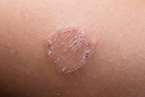 Afbeelding van een stuk huid met de huidschimmel ringworm zichtbaar