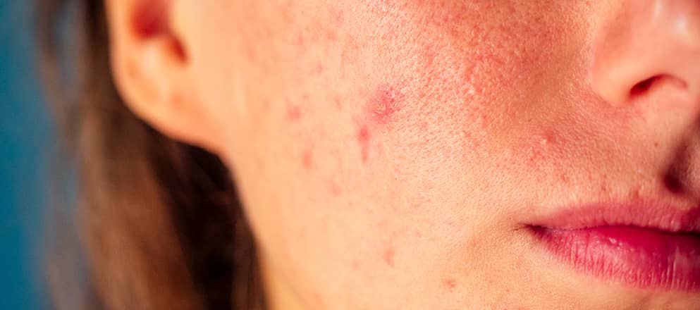 Close up van een gezicht met acne